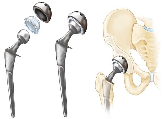 hip replacement surgery process