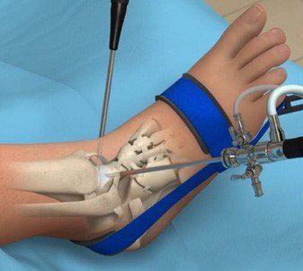 ankle arthrocopy