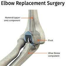 elbow replacement