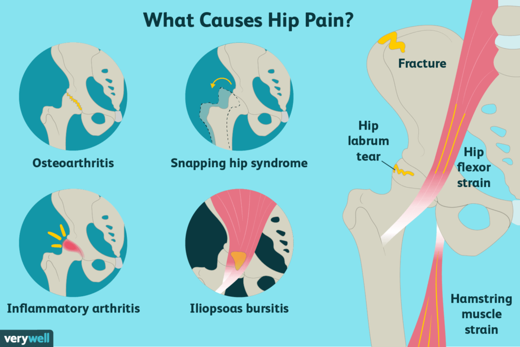 hip pain causes