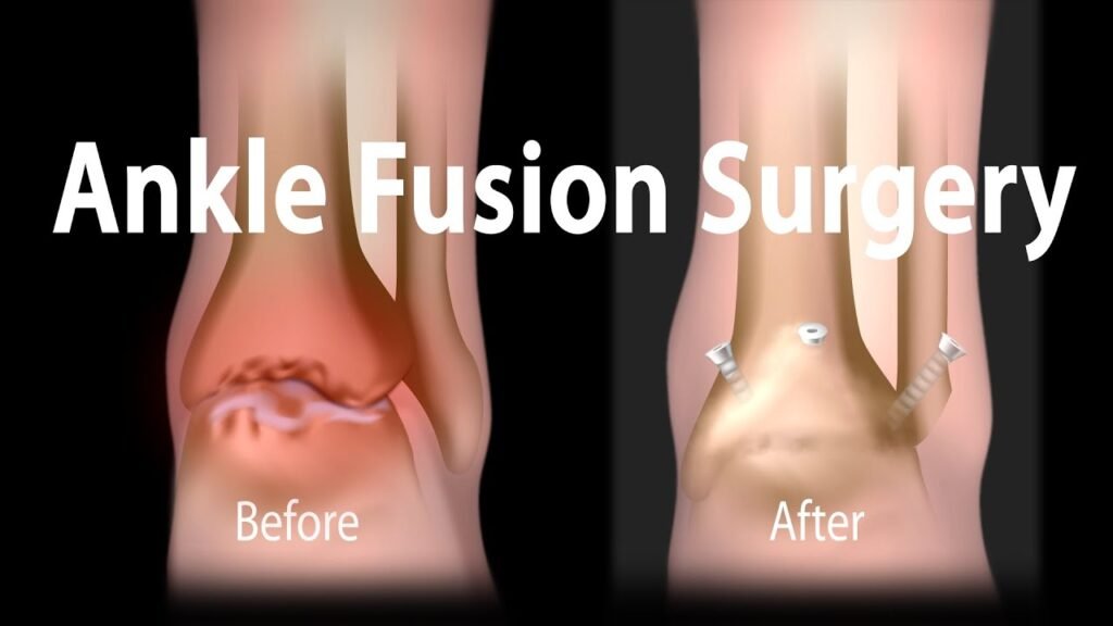 ankle fusion surgery