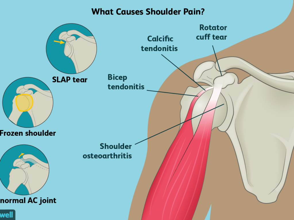 shoulder pain cause