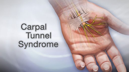 carpal tunnel release